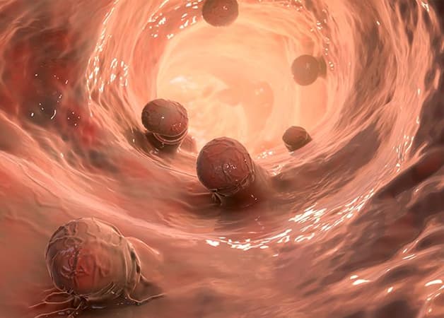 Polyp có thể phát triển ở bất cứ vị trí nào trong đại tràng.