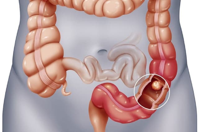 Những điều cần biết về polyp đại trực tràng 