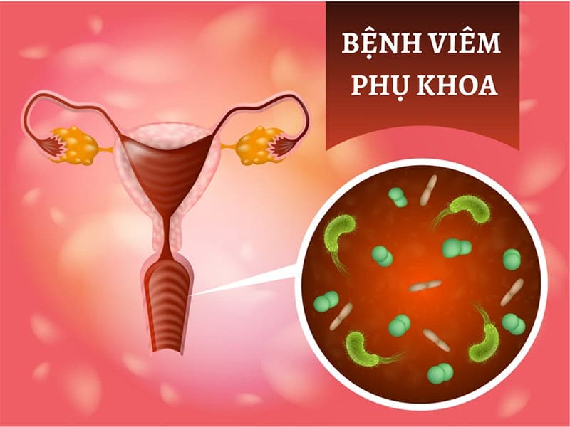 Viêm nhiễm phụ khoa là tình trạng cơ quan sinh dục nữ bị vi khuẩn, nấm, trùng roi,.. xâm nhập và gây nên viêm nhiễm