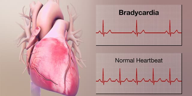 Các dạng rối loạn nhịp tim chậm và cách điều trị