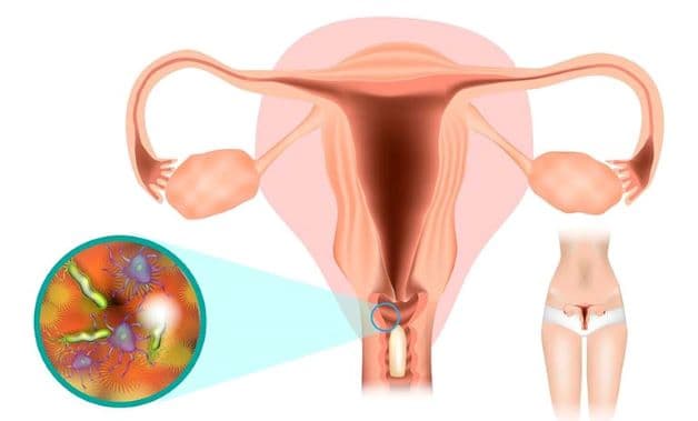 Viêm, nhiễm khuẩn âm đạo có thể là một trong những nguyên nhân gây ra tình trạng rong kinh thời kỳ tiền mãn kinh