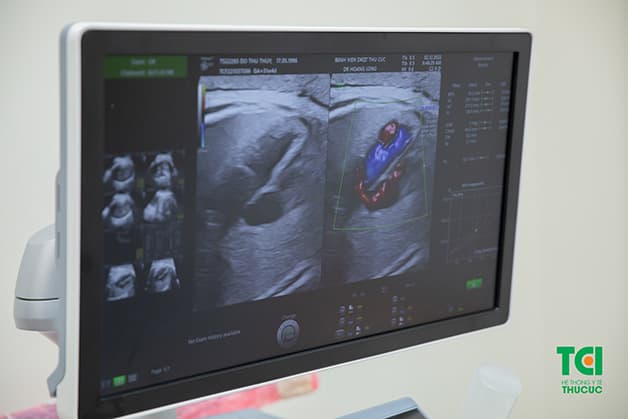 Siêu âm 2D là kỹ thuật siêu âm được ứng dụng trong hầu hết các mốc khám thai, giúp đánh giá tim thai, tình trạng bánh rau, nước ối, động mạch tử cung, ống tĩnh mạch