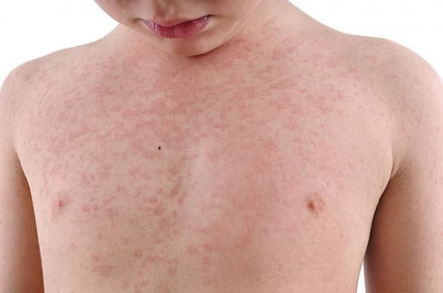 sốt phát ban trẻ em có thể do virus sởi gây ra