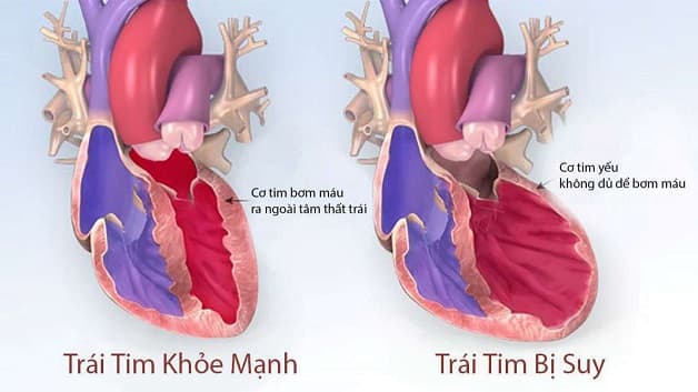 suy tim trái là bệnh gì?