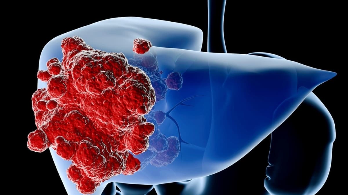 Tầm soát ung thư gan ở đâu tại Hà Nội?