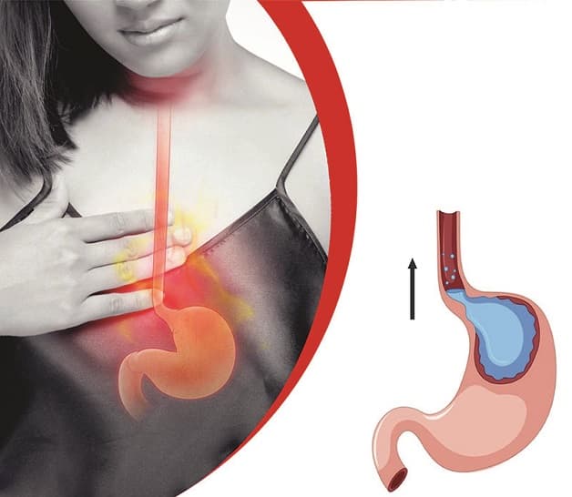 trị trào ngược bằng chế độ ăn