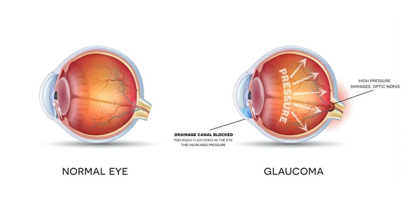 Tìm hiểu ngay triệu chứng của bệnh thiên đầu thống