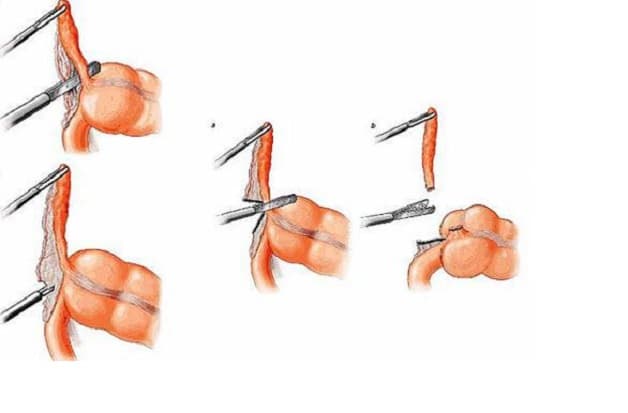 điều trị triệu chứng đau ruột thừa