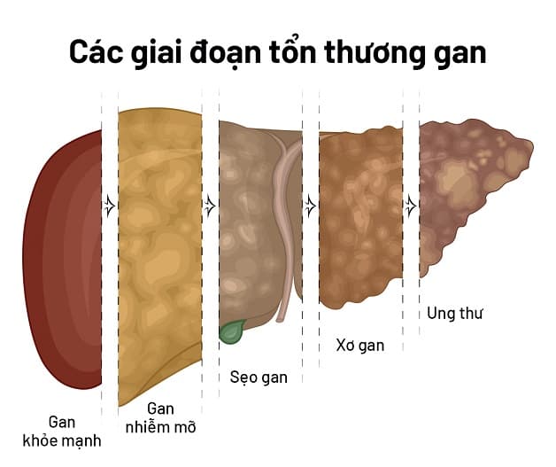 Triệu chứng gan nhiễm mỡ ở giai đoạn 3 trở nên rầm rộ