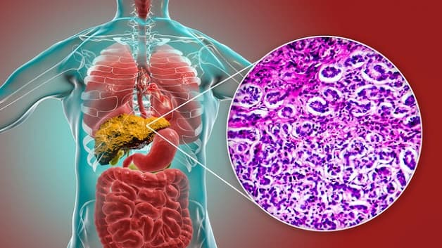 Bệnh gan nhiễm mỡ giai đoạn đầu thường không có triệu chứng.