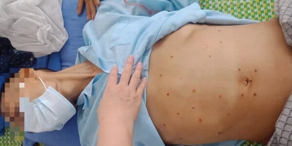 Triệu chứng xơ gan sao mạch ở bệnh nhân