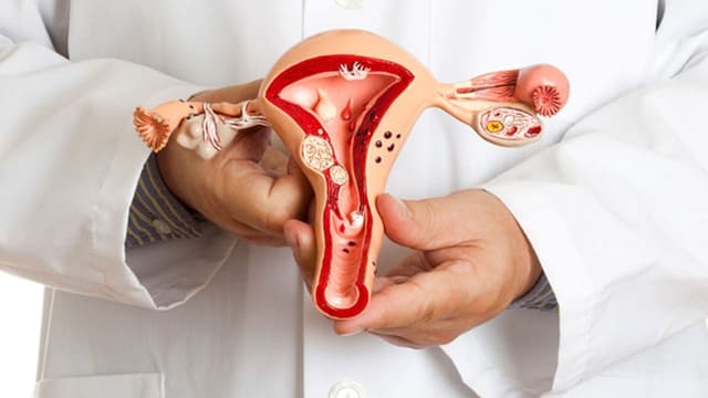 U đa thùy buồng trứng – Nguyên nhân, dấu hiệu và cách điều trị