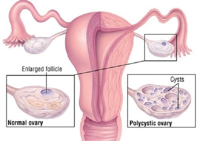 U đặc buồng trứng và những nguy hiểm tiềm ẩn
