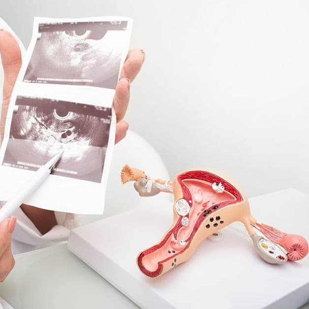 Bệnh u nang buồng trứng có chữa được không?