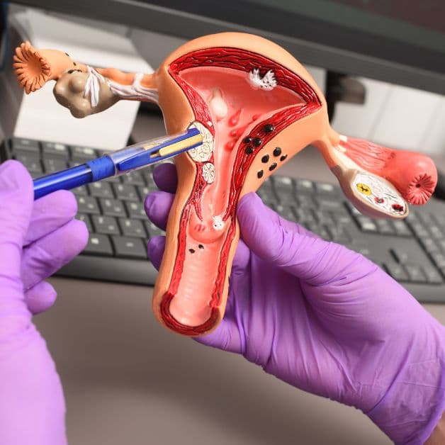 Giải đáp thắc mắc cho chị em u xơ tử cung có đặt vòng được không