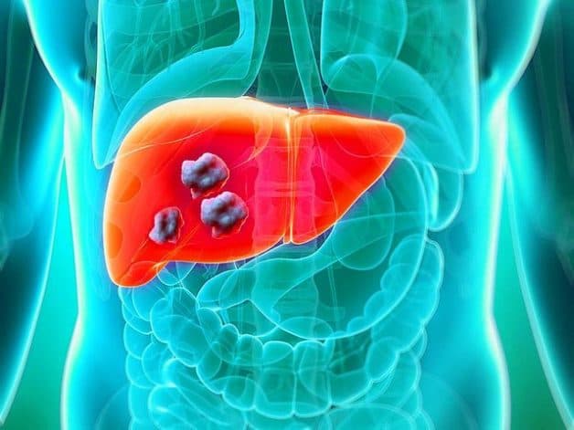 Bệnh ung thư gan có nguy hiểm không