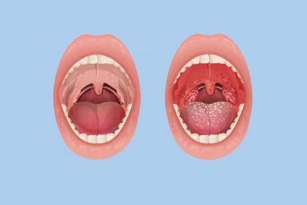 Viêm amidan là bệnh lý đường hô hấp trên thường gặp ở trẻ nhỏ