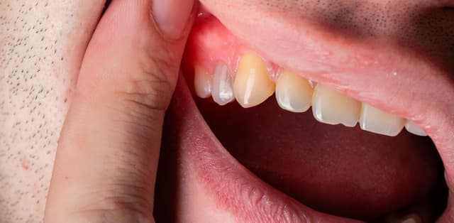 Xử trí khi bị viêm chân răng giả