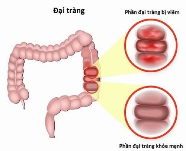 Viêm đại tràng cấp tính là gì