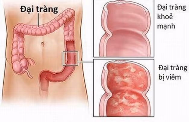 điều trị viêm đại tràng không xác định