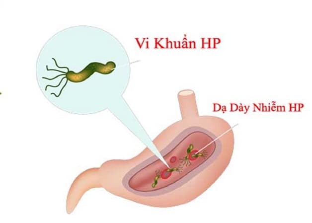 phòng ngừa viêm HP dạ dày