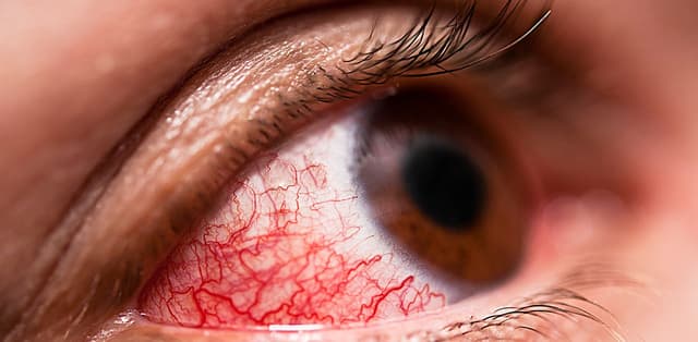 Viêm kết mạc bao lâu thì khỏi và lời giải đáp chuẩn