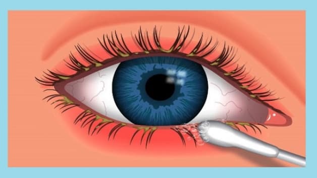 viêm kết mạc bờ mi bao lâu khỏi