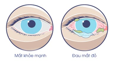 Phương pháp điều trị bệnh viêm kết mạc cấp tính?