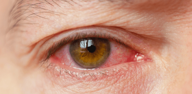 Viêm kết mạc có lây không và cách phòng tránh