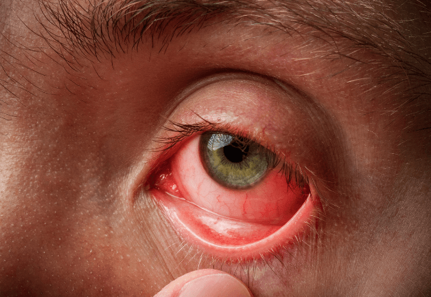 Viêm kết mạc có lây không, đáp án là có và thậm chí có khả năng lây lan nhanh