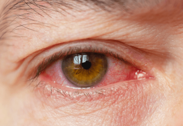 Viêm kết mạc là bệnh phổ biến về mắt do virus, vi khuẩn, dị ứng hoặc vệ sinh mắt sai cách gây ra