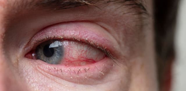 Viêm kết mạc có nguy hiểm không? Bao lâu thì khỏi?