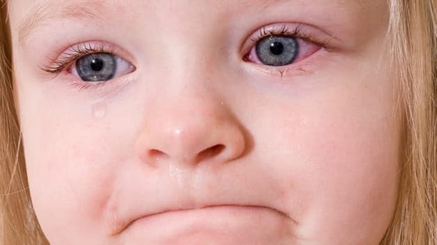 viêm kết mạc lây qua đường nào phổ biến