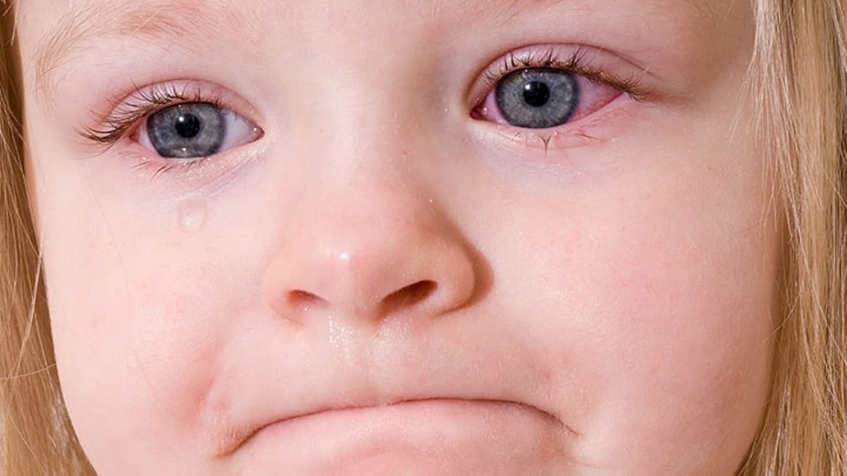 Giải đáp: Viêm kết mạc lây qua đường nào?