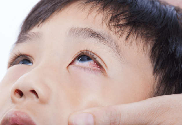 Viêm kết mạc khá phổ biến ở trẻ và được đánh giá là lành tình