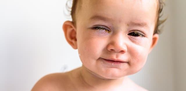 Cách chữa viêm kết mạc ở trẻ 2 tuổi đơn giản