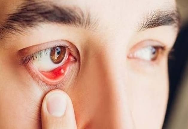 viêm kết mạc sạn vôi là gì