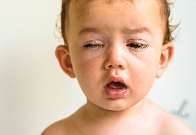 Ai cũng có thể bị viêm kết mạc, kể cả trẻ sơ sinh và trẻ nhỏ