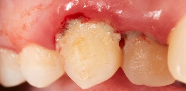 Những điều cần biết về viêm lợi loét hoại tử cấp