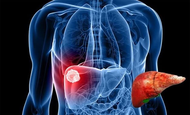 xét nghiệm ung thư gan