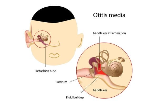 Viêm tai giữa ở trẻ em thường hình thành do biến chứng của một số bệnh lý về mũi họng