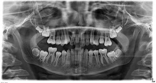 Chụp X quang răng 