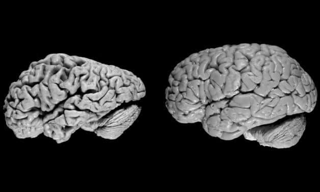 alzheimer là gì, có biểu hiện bệnh như thế nào 