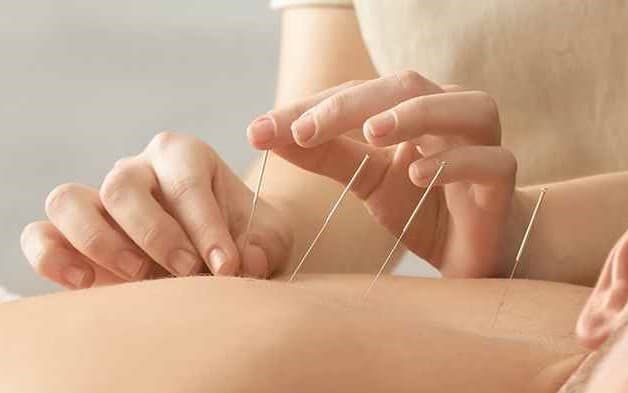 Phương pháp Đông Y - châm cứu cũng là một trong 3 cách điều trị mất ngủ hiệu quả