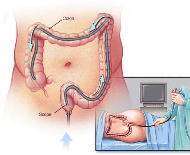 Nội soi đại tràng để chẩn đoán Crohn bệnh học