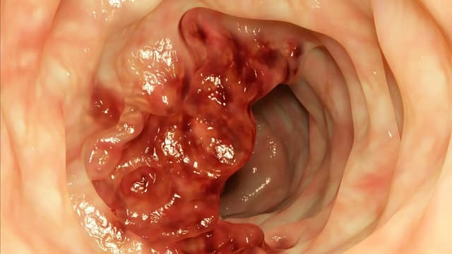 Tìm hiểu chế độ ăn sau phẫu thuật ung thư đại tràng