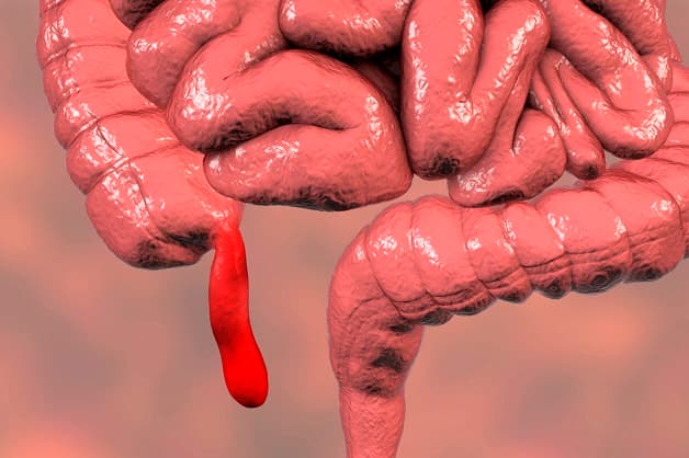 Bệnh viêm ruột thừa cấp