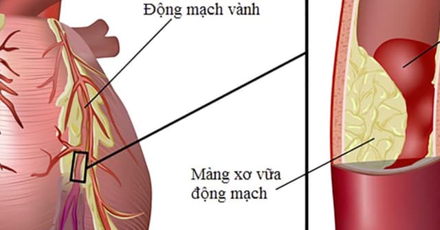 Nguyên nhân bệnh mạch vành và cách điều trị cần biết