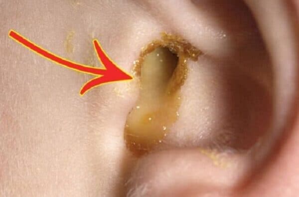 Viêm tai giữa là căn bệnh phổ biến ở trẻ 