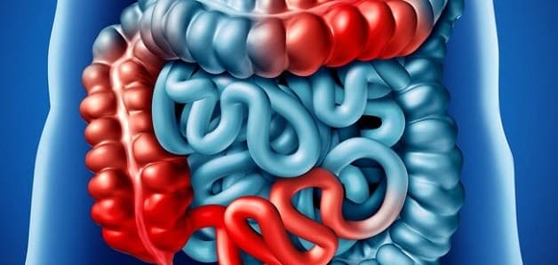 biến chứng bệnh Crohn